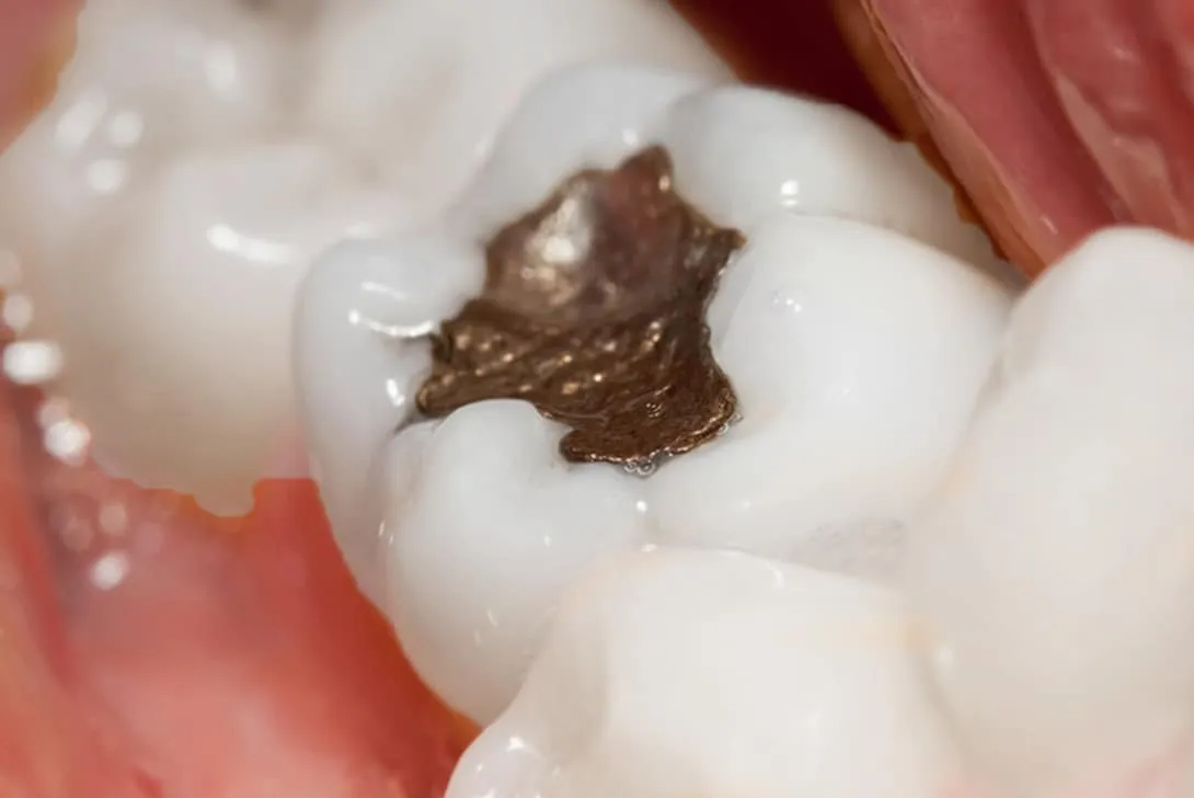 dental fillings - Markham dentists by 7 Days Dental