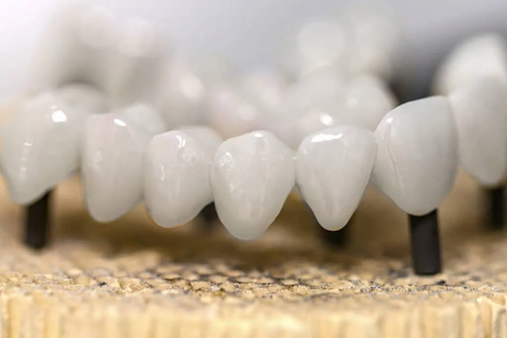 digital impression for crowns - Markham dentists by 7 Days Dental