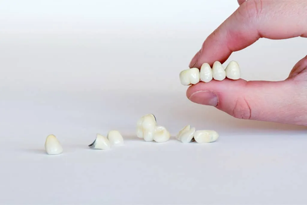 dental bridges - Markham dentists by 7 Days Dental