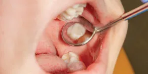 Markham dentist,dental sealants,tooth sealants,preventative dentistry,sealants for kids,sealants for molars,tooth decay,toothache,beautiful teeth,oral health,routine oral hygiene,routine dental visit