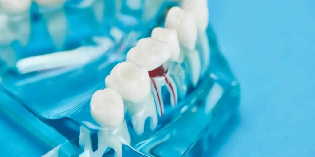 root canal treatment in markham