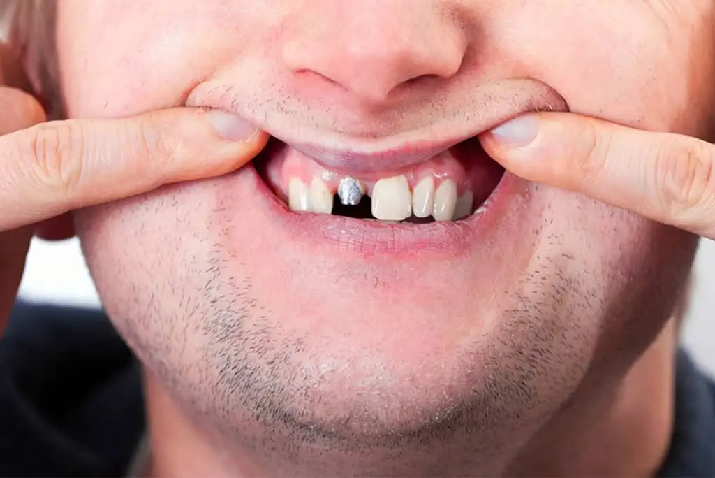 broken tooth - Markham dentists by 7 Days Dental
