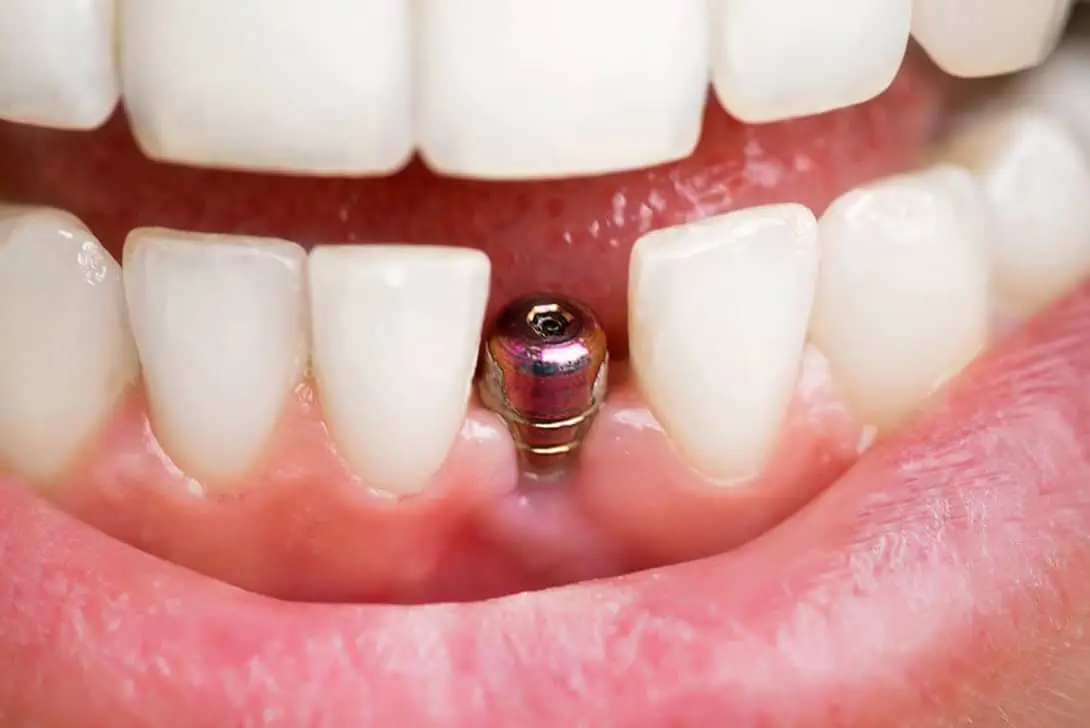 dental implants - Markham dentists by 7 Days Dental