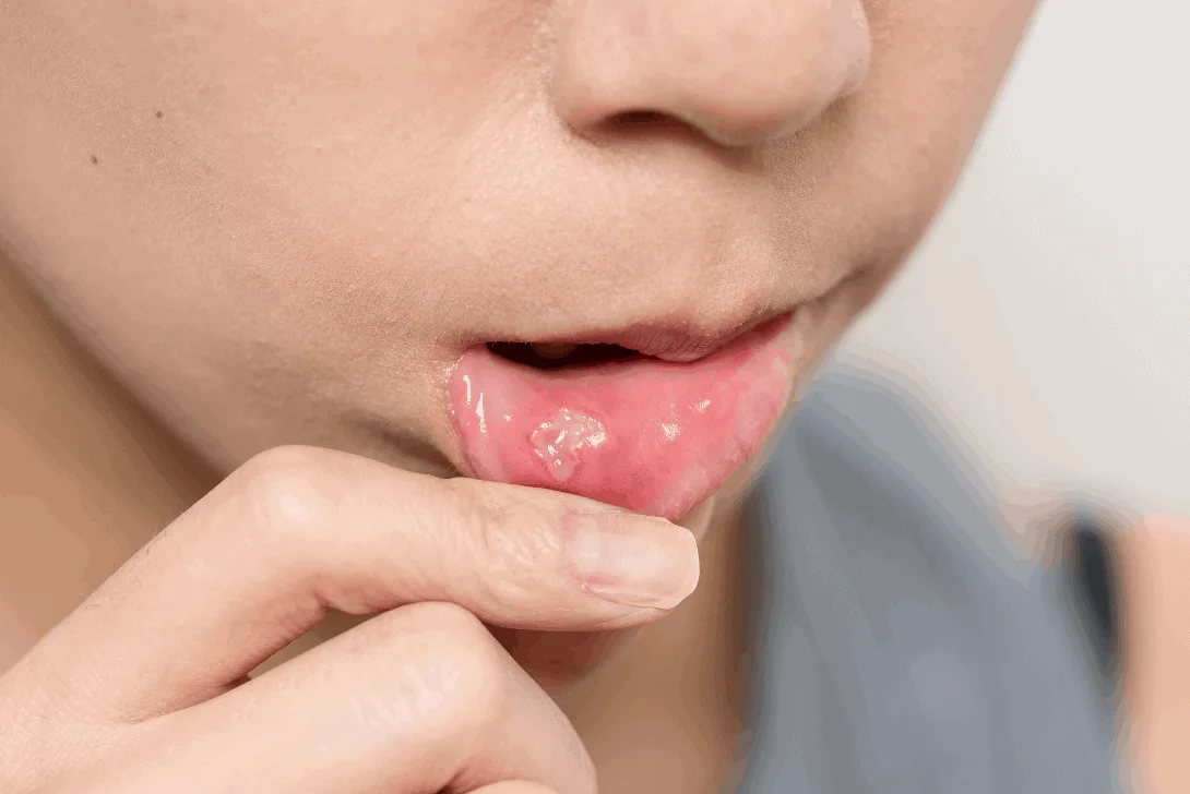 canker sore - Markham dentists by 7 Days Dental