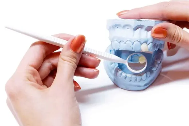 inlays onlays - Markham dentists by 7 Days Dental